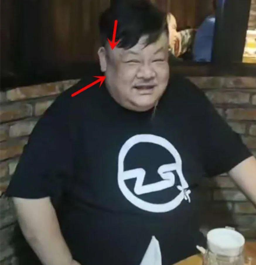 黄瑜娴|9位患罕见病的明星：李宇春患“不死癌症”，黄瑜娴天生没子宫