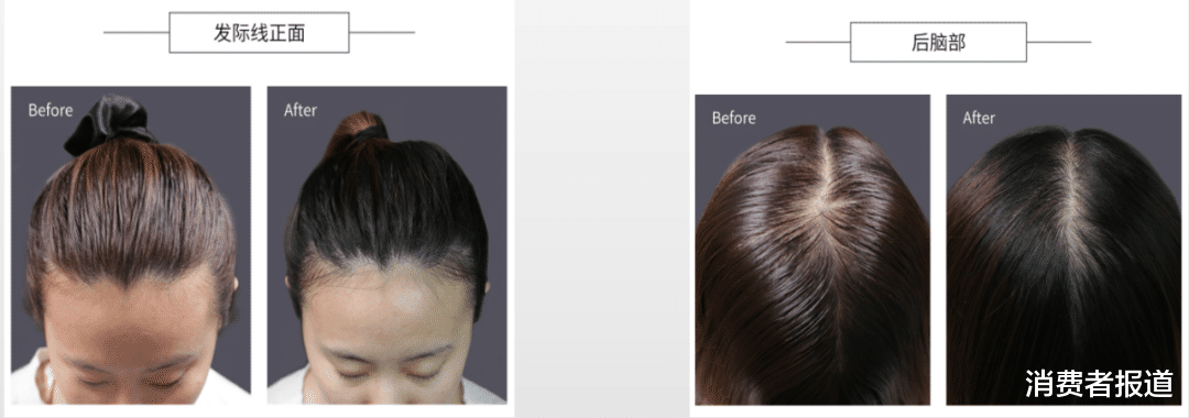 脱发|当代年轻人“脱发”图鉴：我“秃”了？我装的