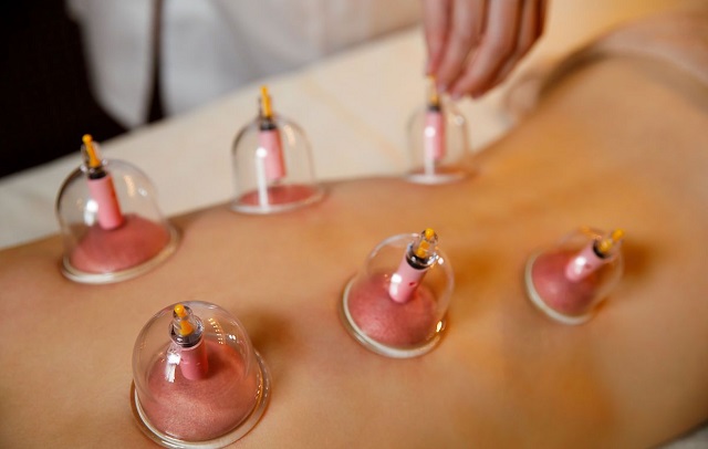 中成药|拔罐后背上的青紫，真的是“毒素”吗？一次全部告诉你