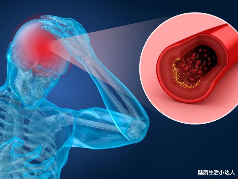 维生素C|中老年人害怕得脑梗?提醒:除了烟酒,五件事也是“祸根”