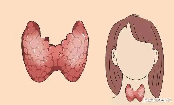 高血压|生姜+花椒泡脚一个月,结节患者都说好