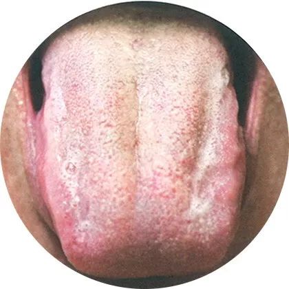 失眠|中医中的舌诊,了解吗