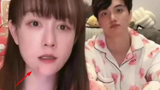 张檬|张檬疑似被家暴，眼眶红肿有淤青，发文秒删，小五表情动作惹争议