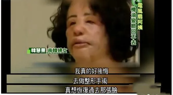 韩慧景|女星韩慧景：为了更漂亮，给脸注射食用油，把脸整成“猪头”