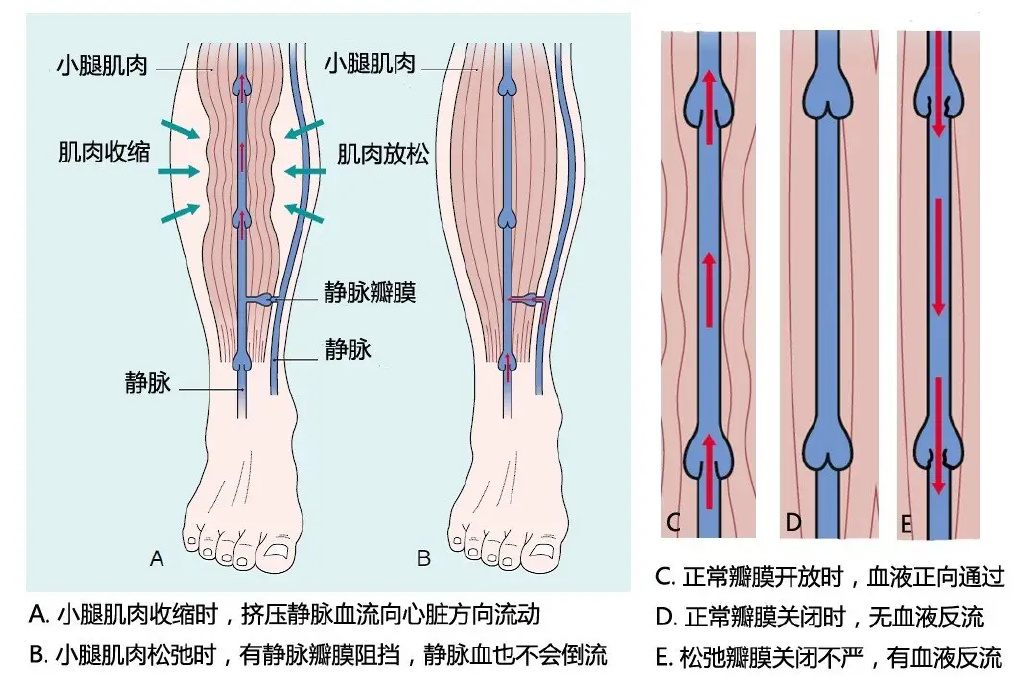 皮炎|有几千万病友的下肢静脉曲张究竟是什么病?钟大夫用你懂的让你懂。