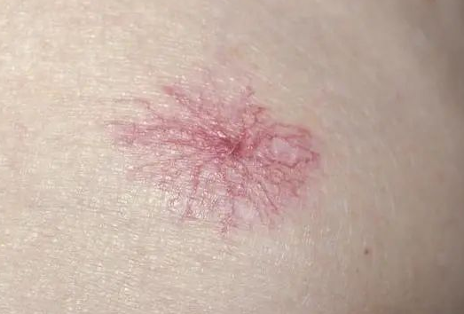 红薯|每天1粗粮竟是肝癌“催化剂”，肝胆主任：尽早停止食用这“1红薯”