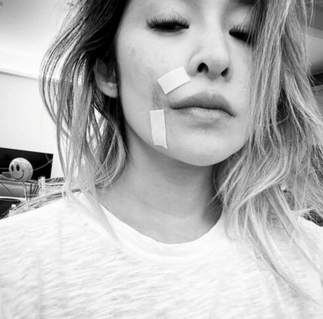 萧亚轩|萧亚轩自曝脸部缺一块肉!鼻子到嘴边伤疤明显,用化妆品疯狂遮盖