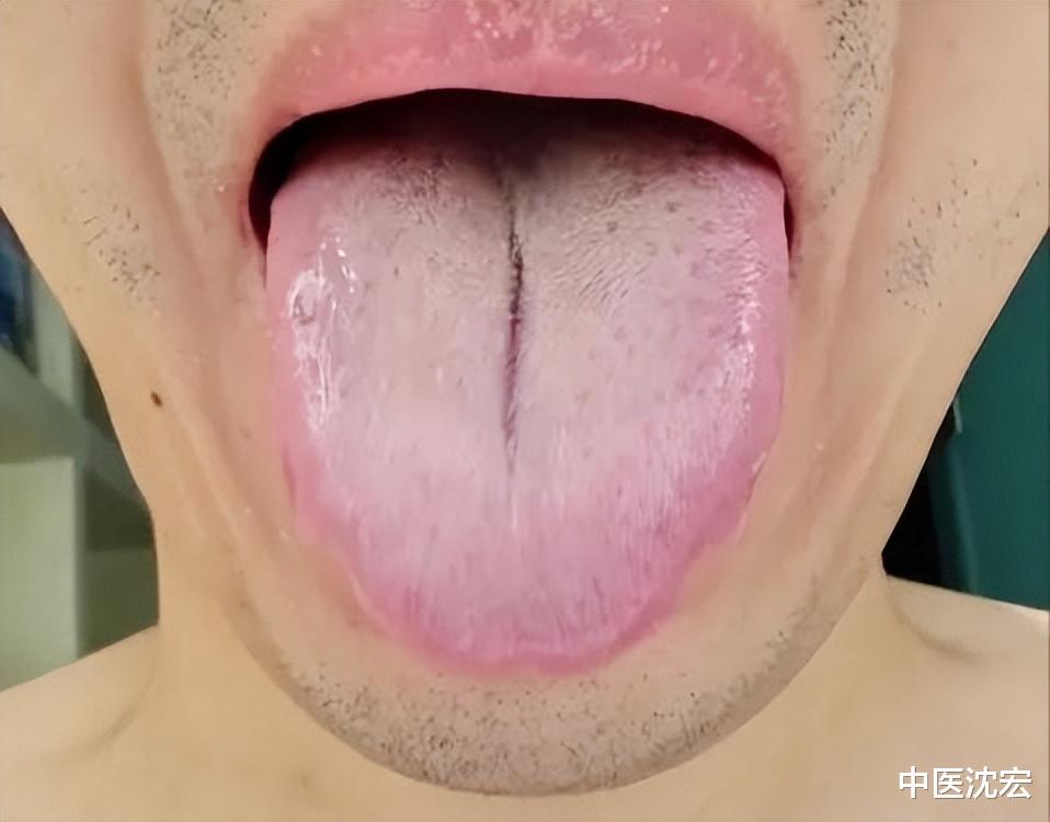 淋巴瘤|舌头有裂纹?可能是脾虚,2味药,一补一泄,健脾祛湿 赶跑裂纹舌