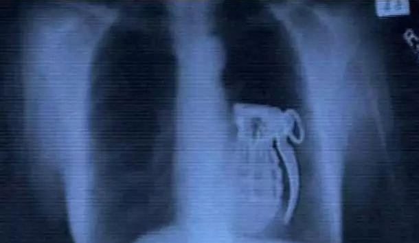 肺癌|盘点30张奇奇怪怪的X光片，看完整个人都不好了！