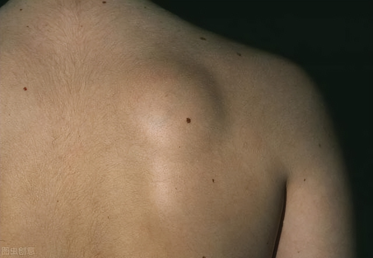 疾病|体内有痰还有淤,痰淤互结怎么办?两味中药,健脾化痰、通络除淤