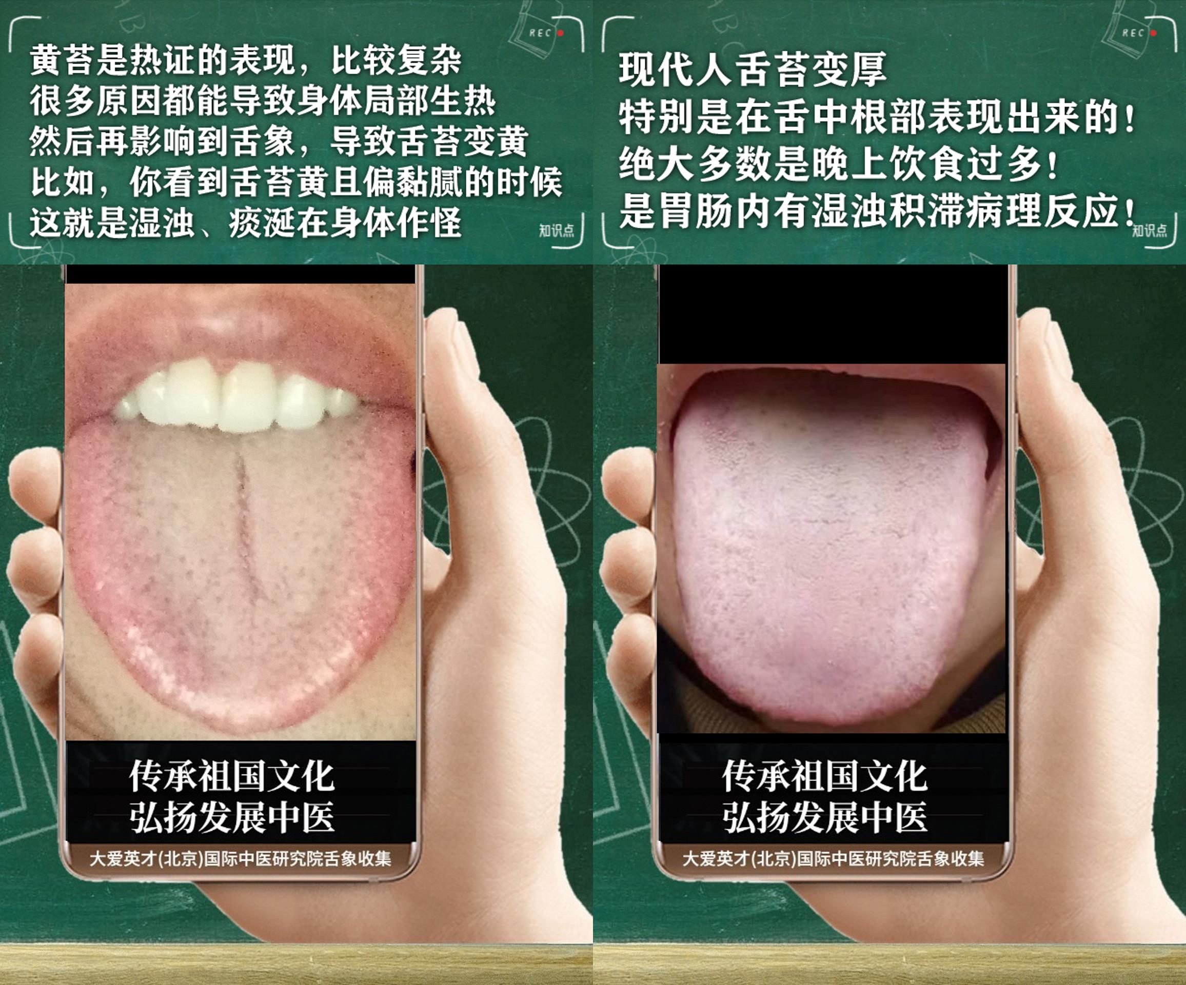 胆固醇|中医医案：易爆躁、无力、胆固醇高、经常反复非常崩溃