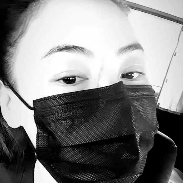 张柏芝|张柏芝自曝被儿子抓伤!伤疤明显口罩挡不住,皮肤油亮发际线高