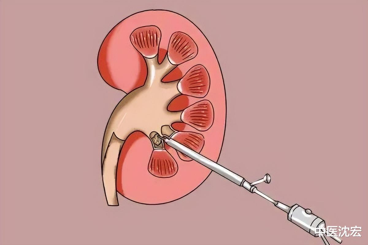 肾结石|一个古方化石汤,击碎肾结石,胆结石,尿道结石,无石无痛一身轻