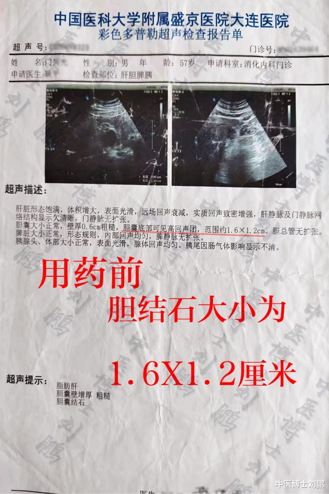 胆结石|胆结石调理案例