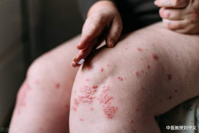 黄柏|分享一味抗癌中药——黄柏,功效清热解毒、泻火燥湿,组方应用多