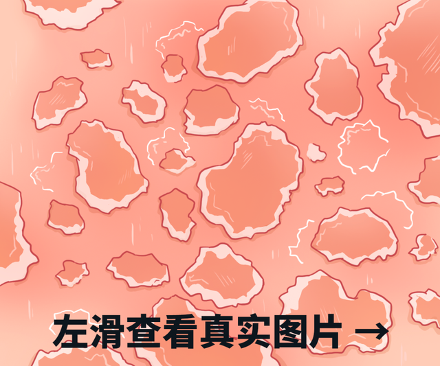 胃炎|警惕！身上的这种小红点是病毒感染，小心越长越多