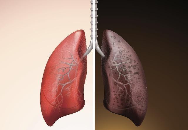 医生|肺好不好看手,若手上没有3个表现,恭喜,或许肺部还算蛮健康的