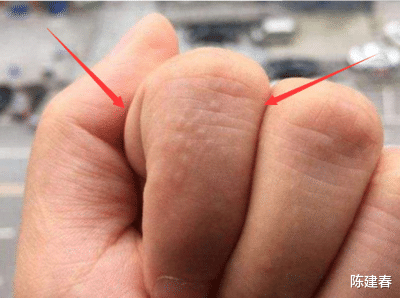 尿酸|如何判断尿酸高不高?看你的手以及睡觉就知道!