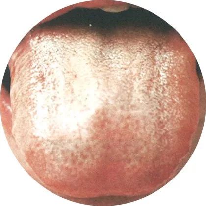 失眠|中医中的舌诊,了解吗