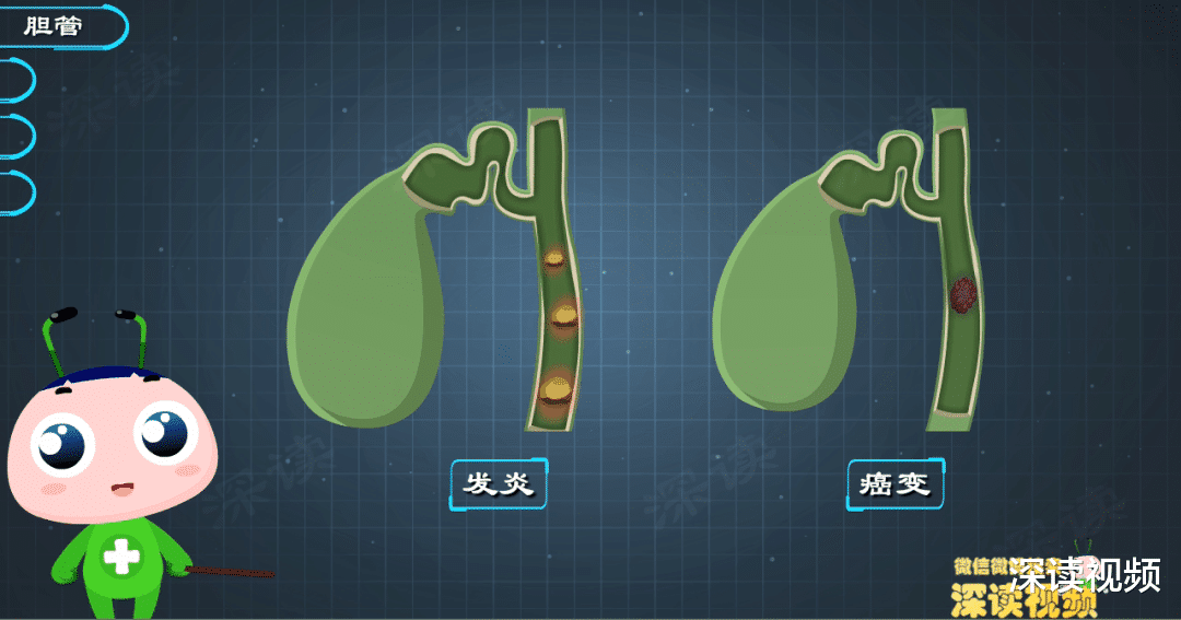 胆管结石|胆管结石是怎么搞坏你的肝，胆，肠，胰的？画得太棒了！