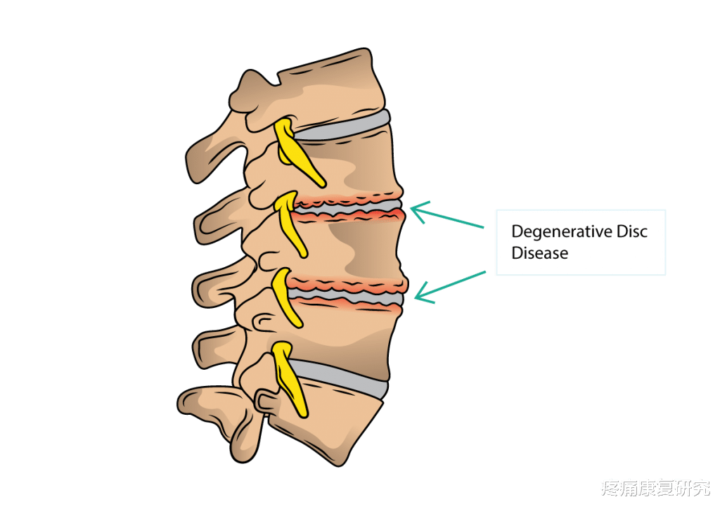 运动|坐骨神经痛的成因和治疗