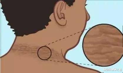 糖尿病|糖尿病是皮肤病?皮肤如果出现4个症状,小心血糖高了