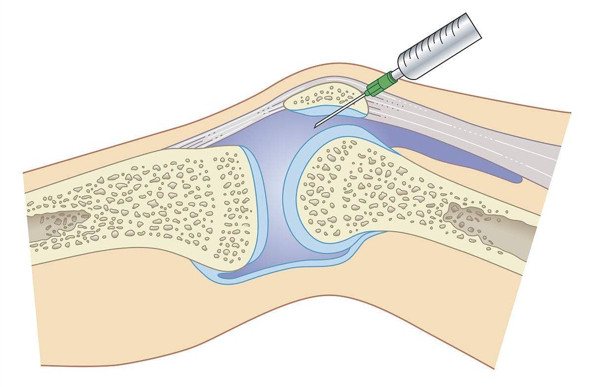 滑膜炎|得了滑膜炎应该怎么办？