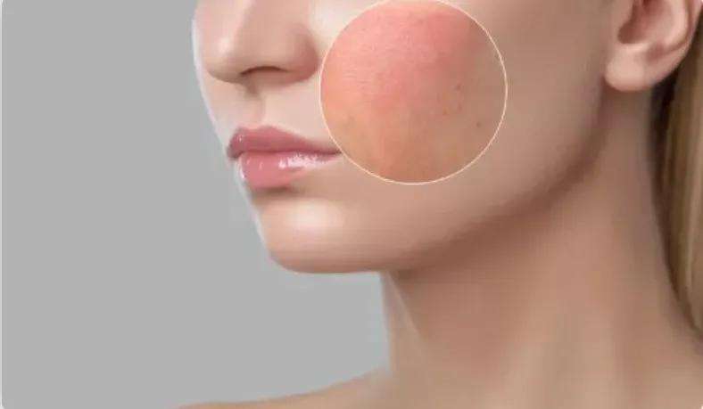 护肤 过年期间，如何维持“敏感肌”的稳定，只需这样做，很实用