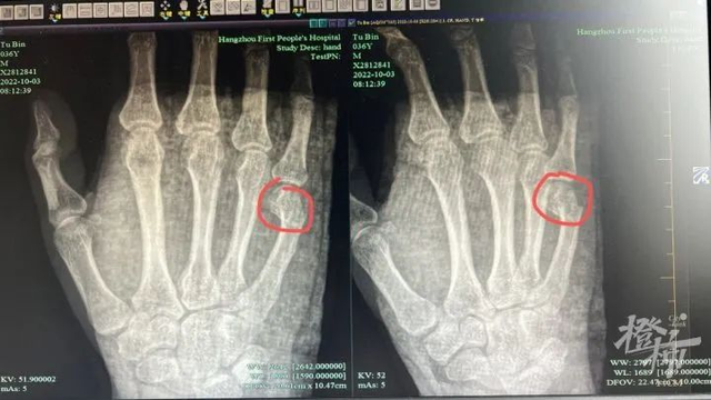 杭州爸爸辅导孩子写作业太生气,一拳头把自己打进医院