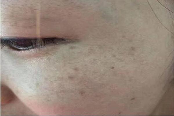 健脾|色斑太多、脾气也差?可能是内分泌失调了,4招助你平衡内分泌