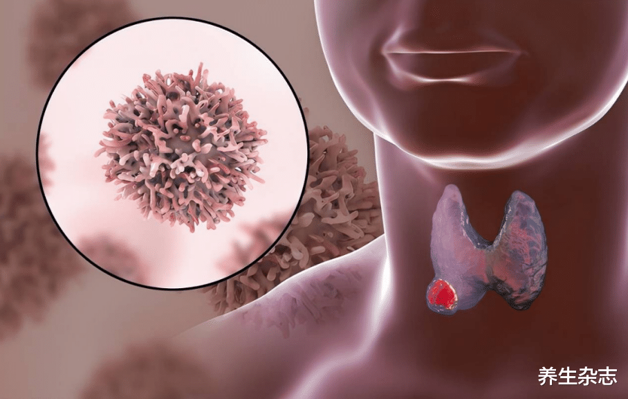 鸡蛋|1天1鸡蛋，患甲状腺结节风险，会增加80％？听听医生怎么说