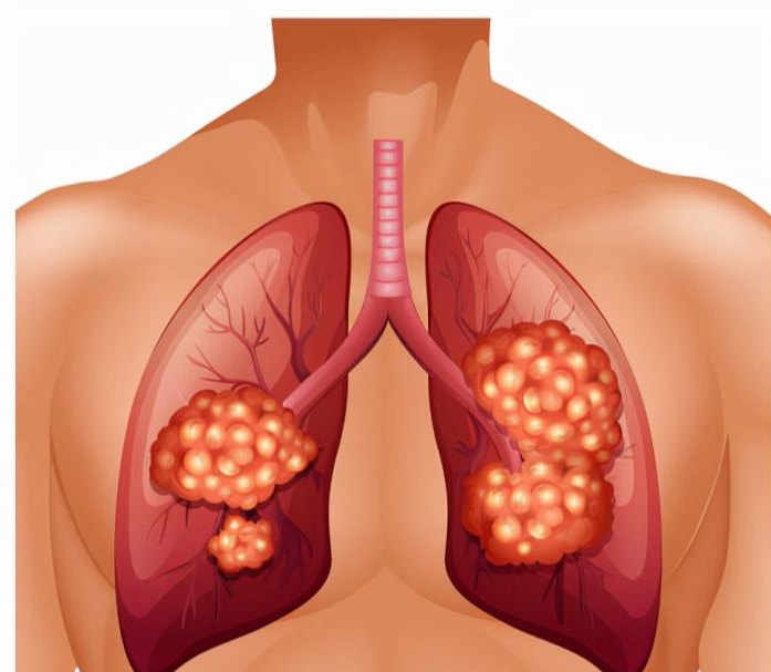 |网友问：3mm的肺结节，不治疗可以吗？
