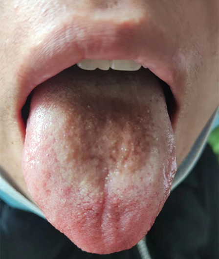 中国科学院|阳了以后舌苔变黑怎么办？
