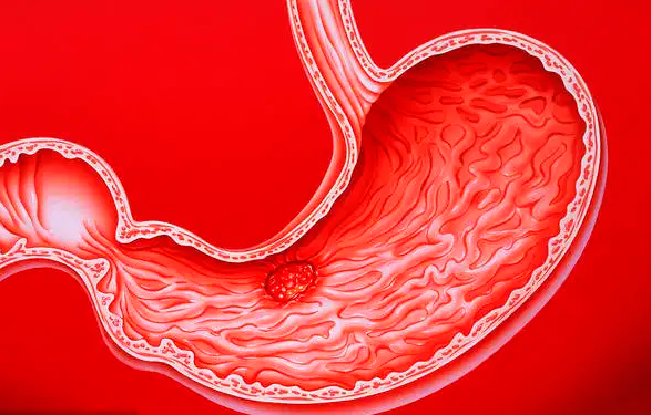 马齿苋|多家医院联合声明：停止饮用“1水”，或是胃癌“加速器”，趁早戒掉