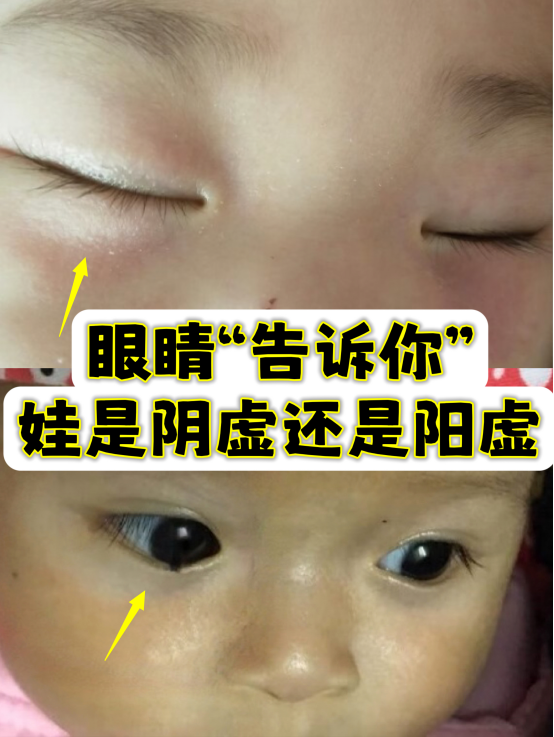 儿童健康|孩子脾胃虚,调理之前要分清是阴虚还是阳虚