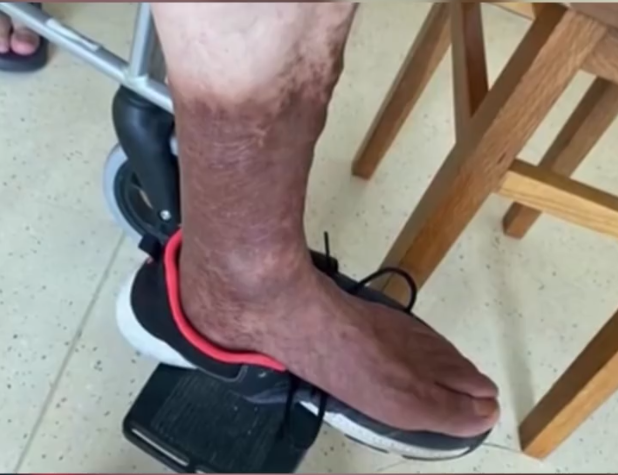 静脉曲张|六旬老人本想舒舒服服泡个脚,没想到竟加重了老毛病,双腿发黑!