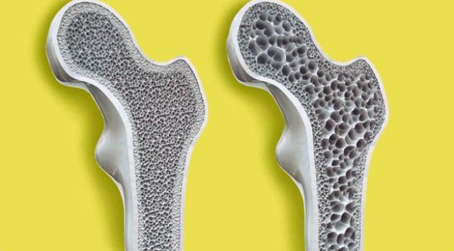 胰腺炎|68岁老人常吃“1物”,骨密度从0.8到了3.5,腿不疼、骨质疏松改善