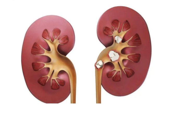 近视|多家医院联合声明:厨房“2素”停止食用,小心肾脏“烂如渔网”