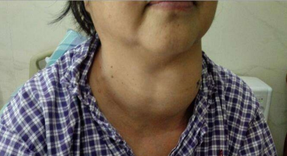 运动 27岁女子坚持跳绳减肥，确诊甲状腺癌，医生惋惜：运动前1习惯害了她
