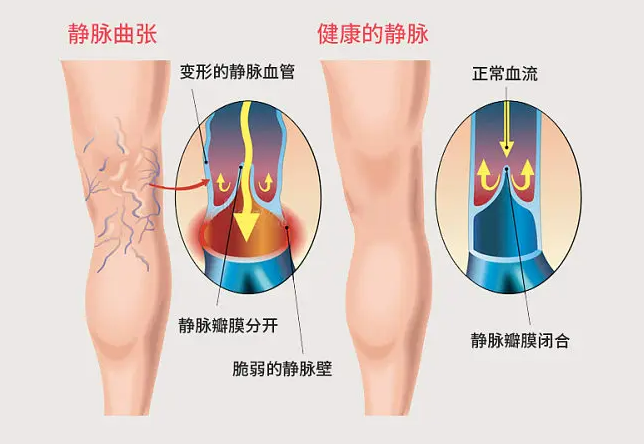 |疼、肿、痒、麻？腿上出现这4种症状当心是它！