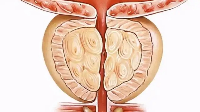 养生|得了前列腺钙化,对身体有影响吗?