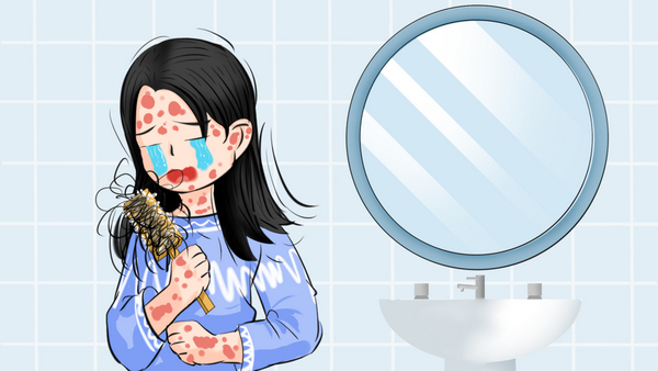 牛皮癣|为什么用药之后牛皮癣反跳更严重了？