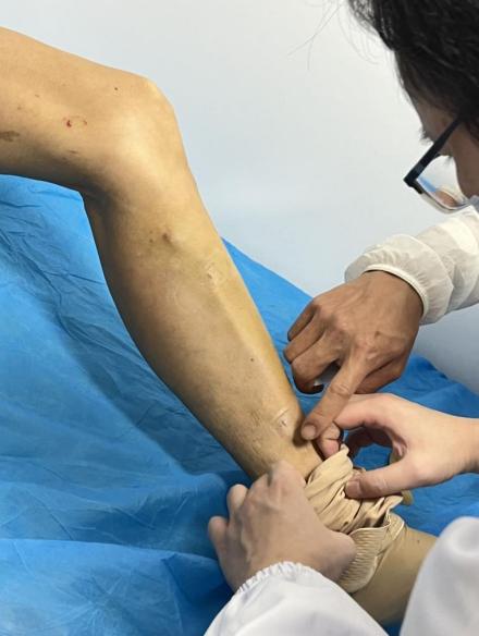 静脉曲张|57岁阿姨腿鼓大包、脚踝溃烂，「逃离」城郊 三个针孔破局