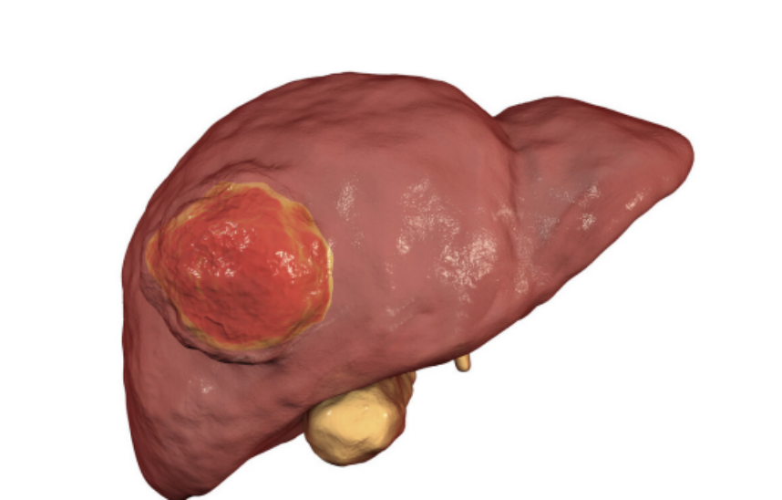 新型冠状肺炎|每天早起一杯“水”，42岁民工肝癌离世，医生叹息：无异于饮“毒水”