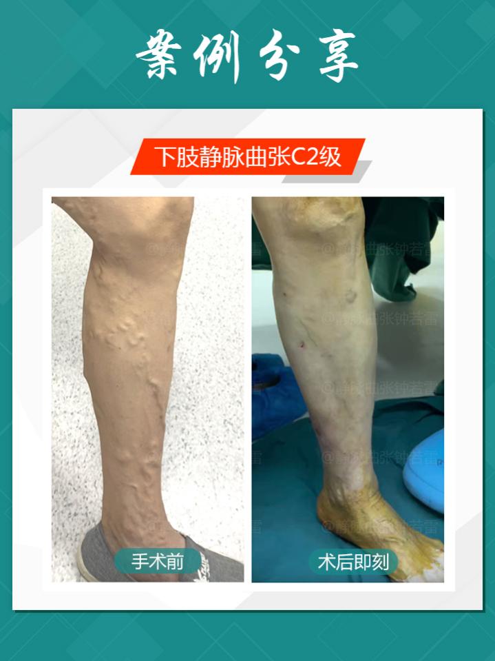 静脉曲张|蚯蚓腿小腿爆青筋是为何？六旬培训师小腿爆青筋，直呼跳舞难看想“换腿”！