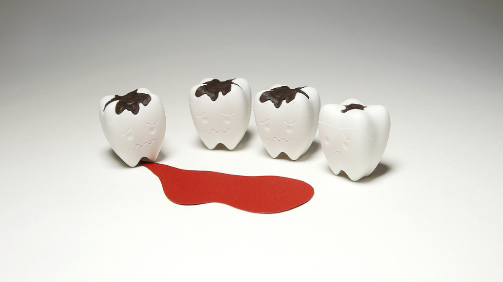 牙龈萎缩|牙周炎引起的牙龈出血、牙龈萎缩如何改善？中医一个小方轻松解决！