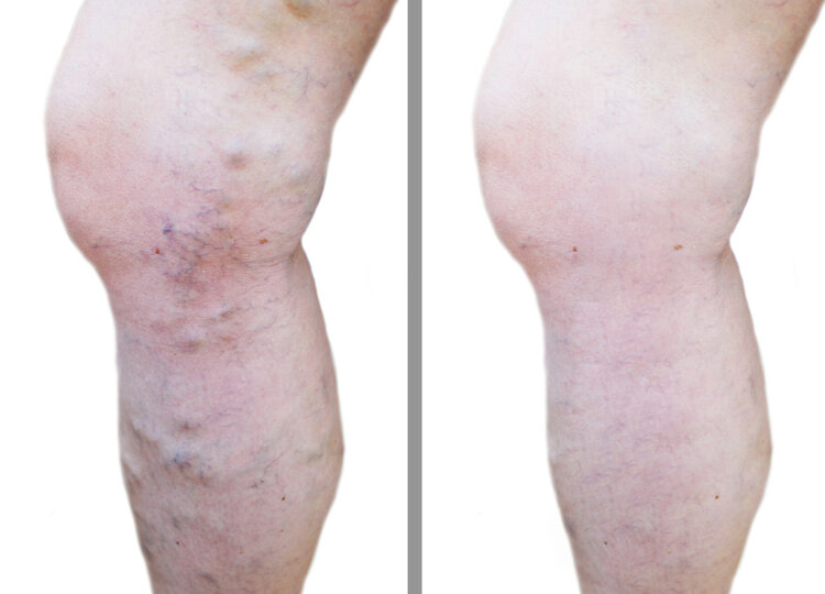 静脉曲张|6个小方法，轻松解决静脉曲张，去掉腿上的“小蚯蚓”！