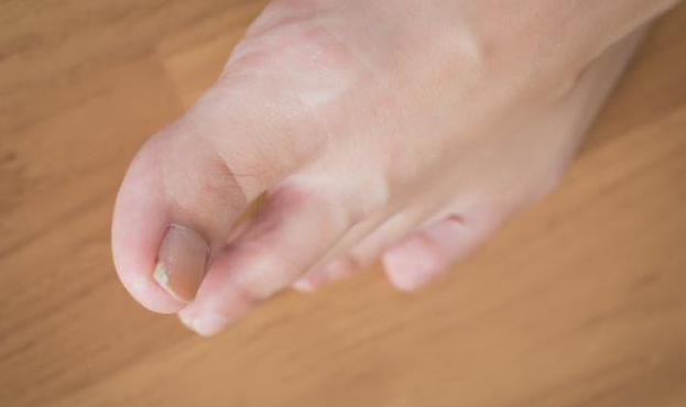 尿酸|身体好不好,看脚就知道!脚上有5个表现,就要注意了