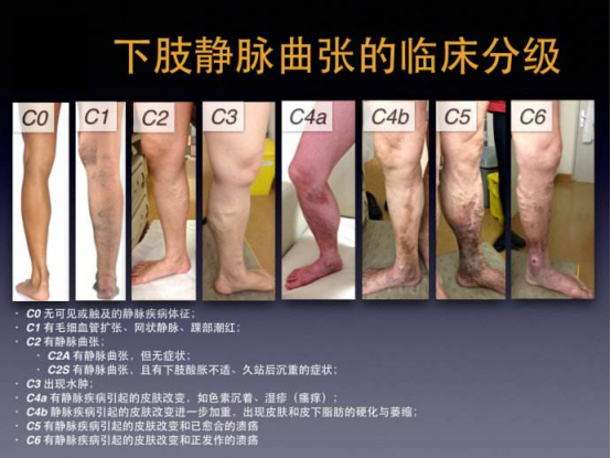 小凌|定性！定级！——你的腿部不适症状是下肢静脉曲张诱发吗？那你又属于哪一级！