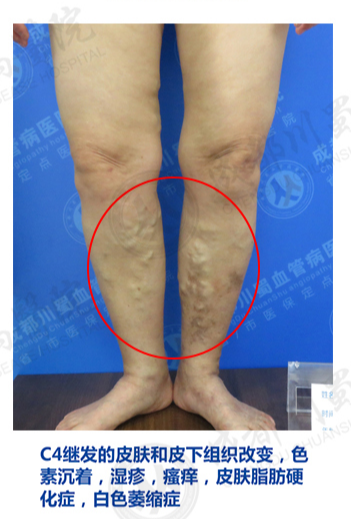 静脉曲张|下肢静脉曲张，要早治！川蜀专家：不要等腿烂了才治，此时久难以根治了！